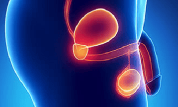 vu-111 - Dolor Testicular Crónico 1