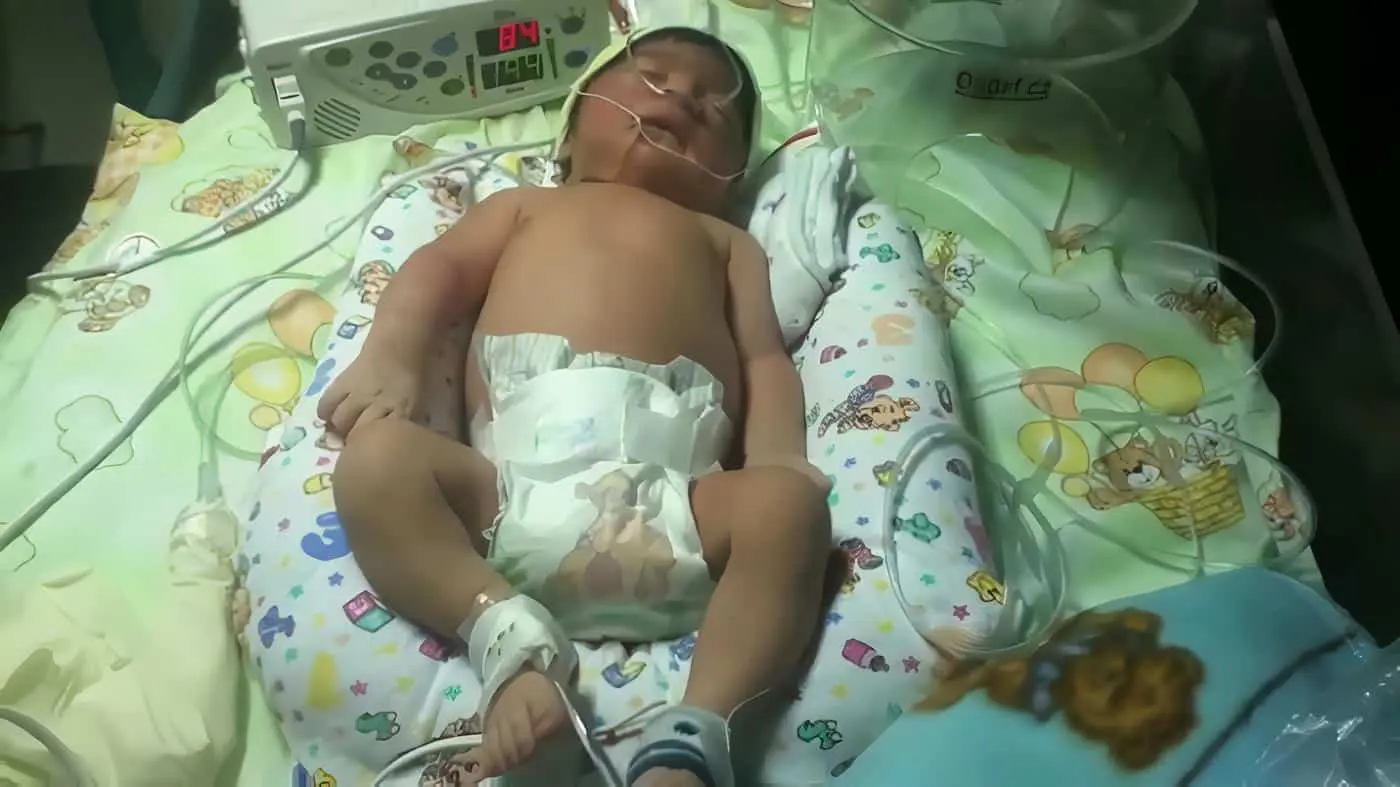 Convulsiones Neonatales