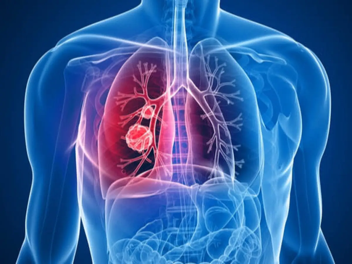 Fisiopatología del tromboembolismo pulmonar