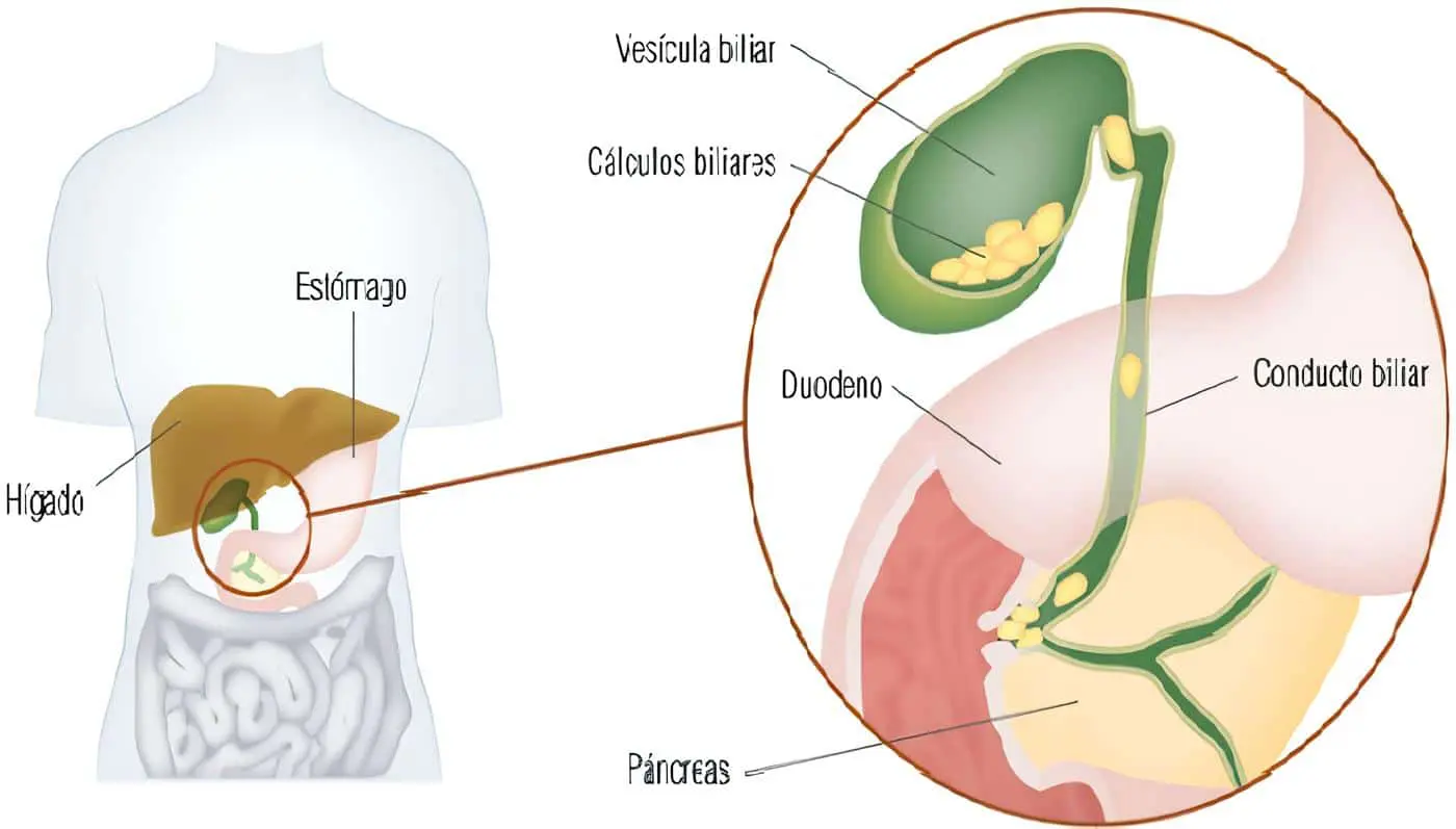 Colecistitis Aguda