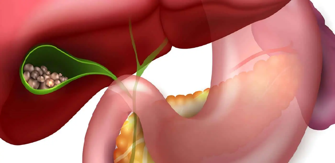 Coledocolitiasis - Colelitiasis