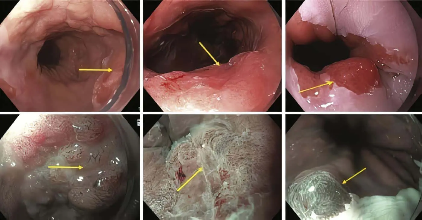 Cromoendoscopia