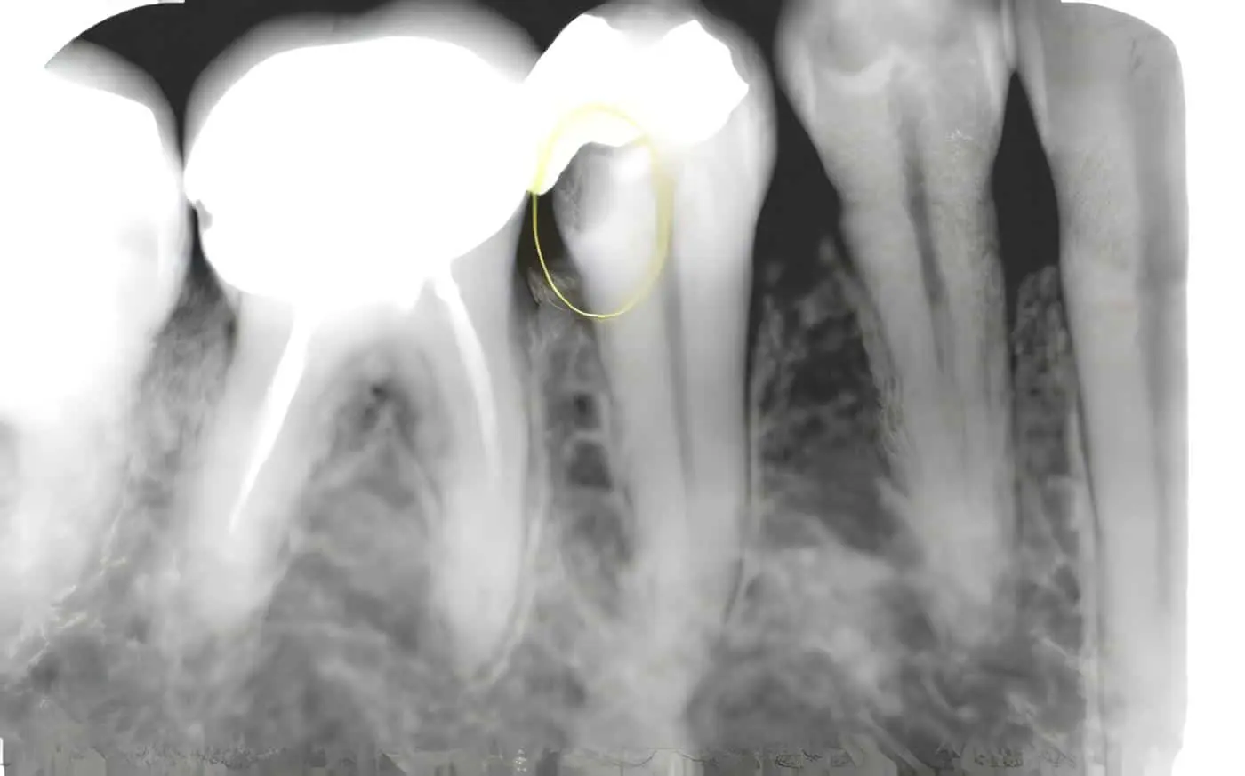 Lesiones Periapicales