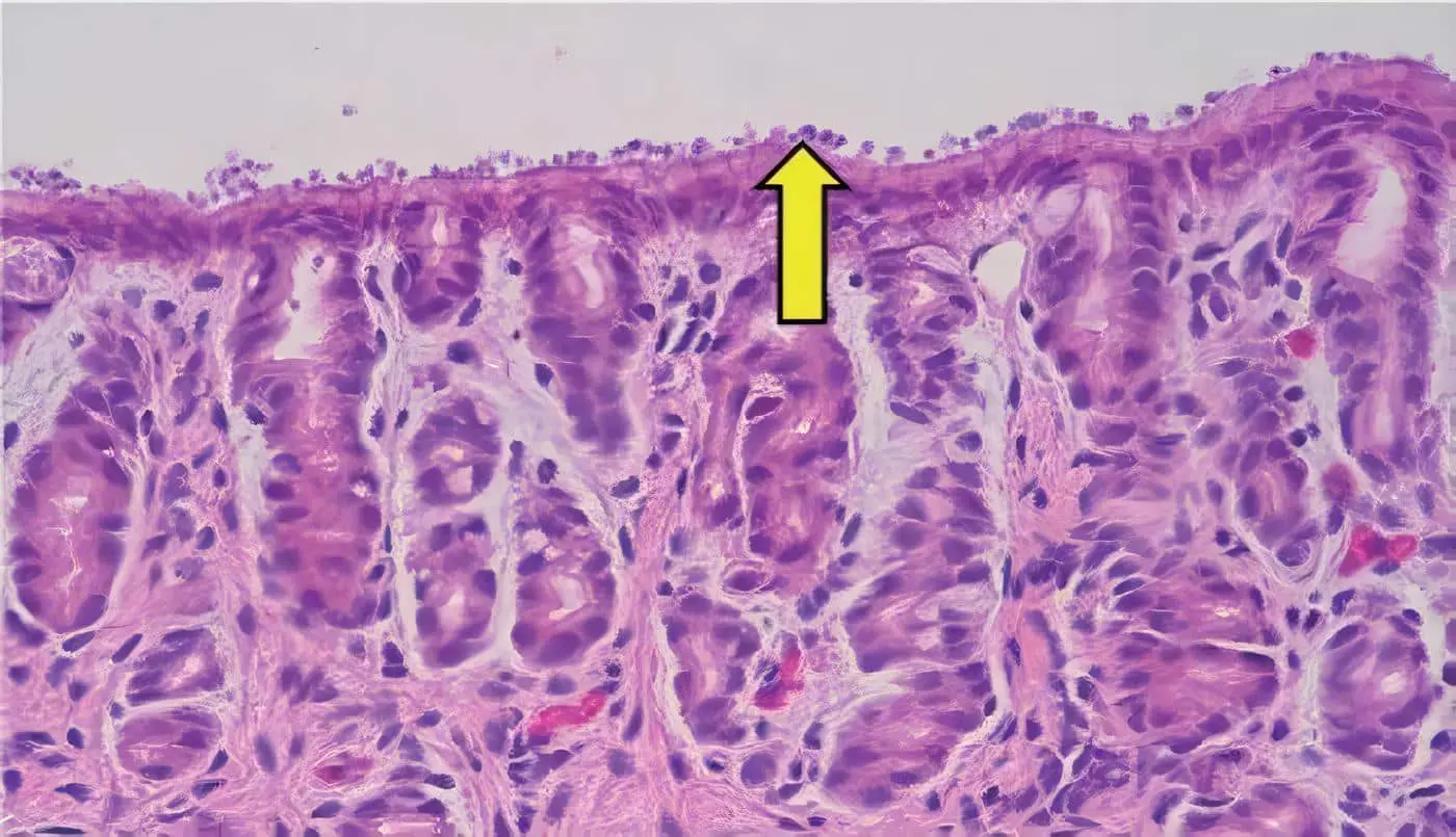 Criptosporidiosis en Niños con Cáncer