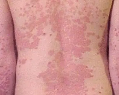 Psoriasis
