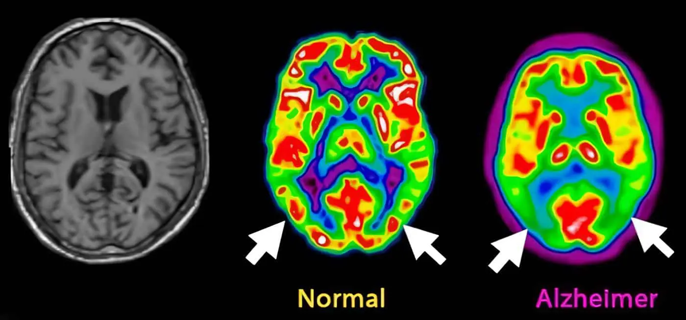 Enfermedad de Alzheimer Diagnóstico