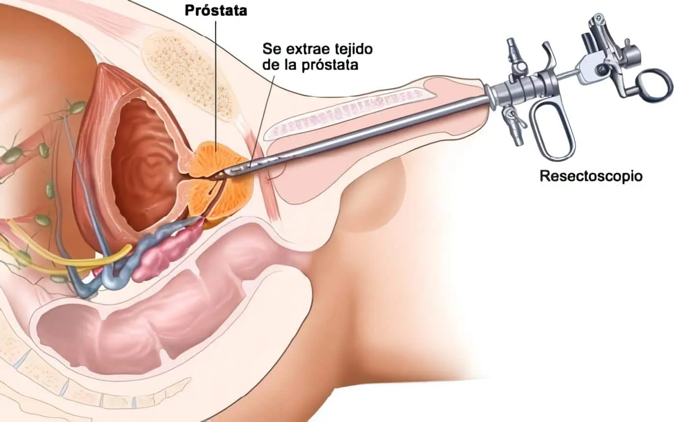 Manejo sonda vesical