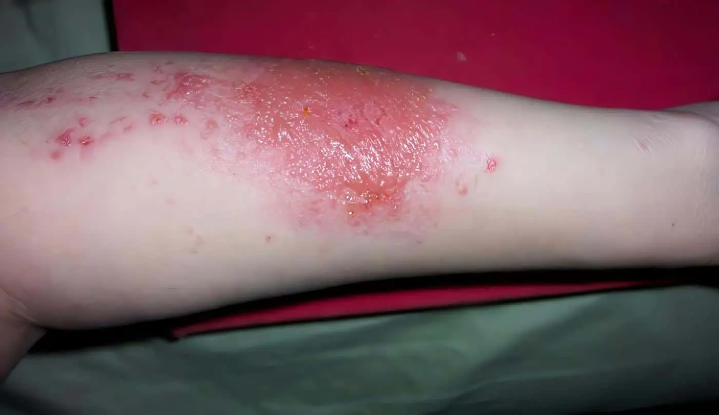 Dermatitis de Contacto Ocupacional