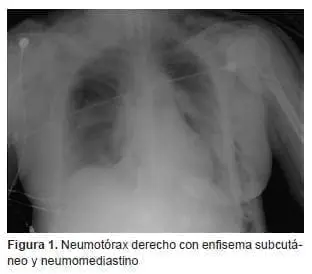 Reconstrucción tráqueal, enfisema subcutá­neo y neumomediastino