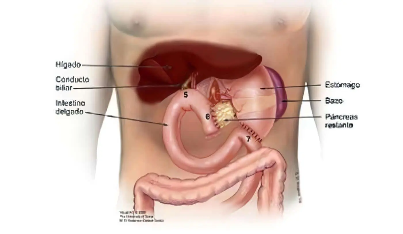 Anastomosis Hepático-Yeyuno