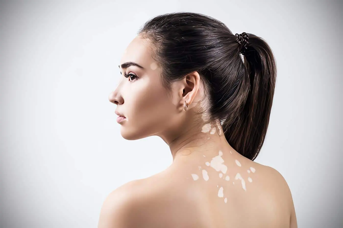 Remedios Caseros para el Vitiligo o Leucodermia