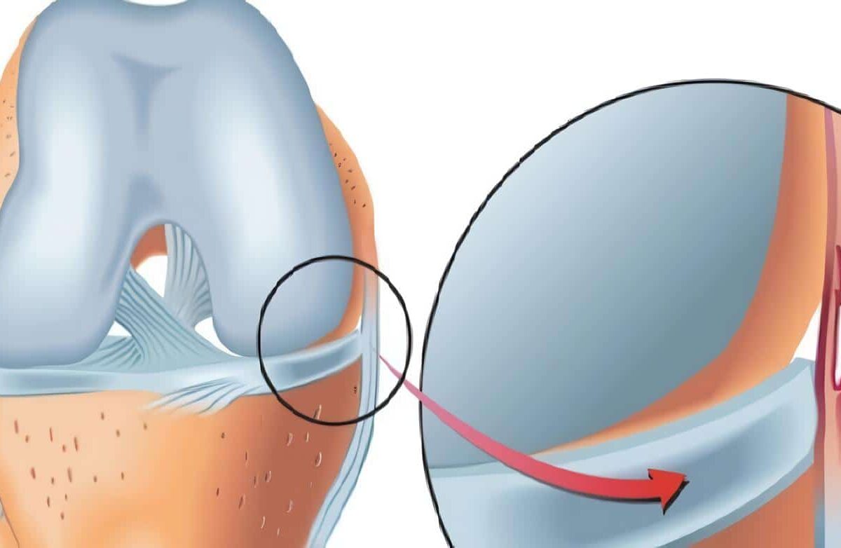 Ligamento Colateral Interno