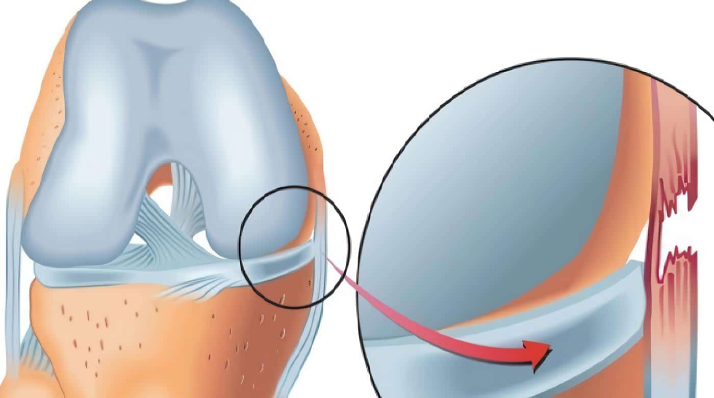 Ligamento Colateral Interno