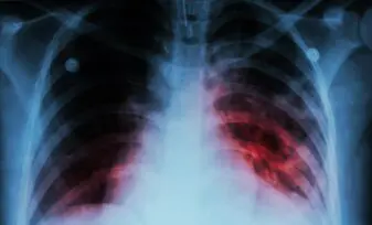 Características psicosexuales de las personas adultas con tuberculosis pulmonar