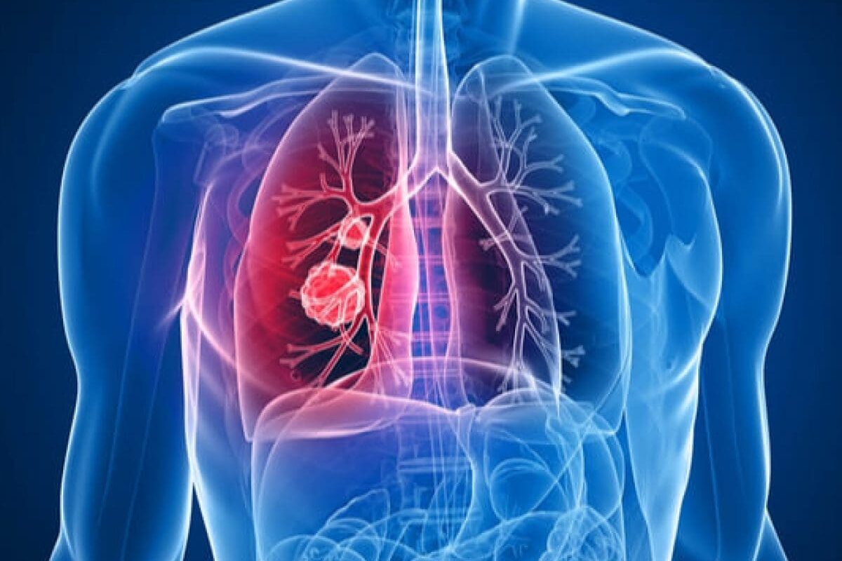 Embolismo pulmonar: comparación prospectiva de la tac helicoidal con la gammagrafía de ventilación- perfusión