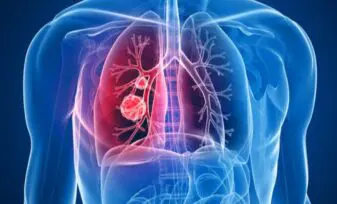 Embolismo pulmonar: comparación prospectiva de la tac helicoidal con la gammagrafía de ventilación- perfusión