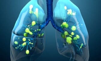 Fase fibroproliferativa en SDRA