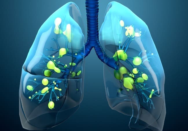 Fase fibroproliferativa en SDRA