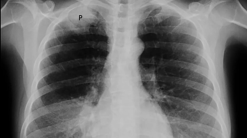 Tumores de la pared torácica: tumor de Askin. Presentación de un caso