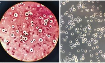 Cryptococcus Neoformans