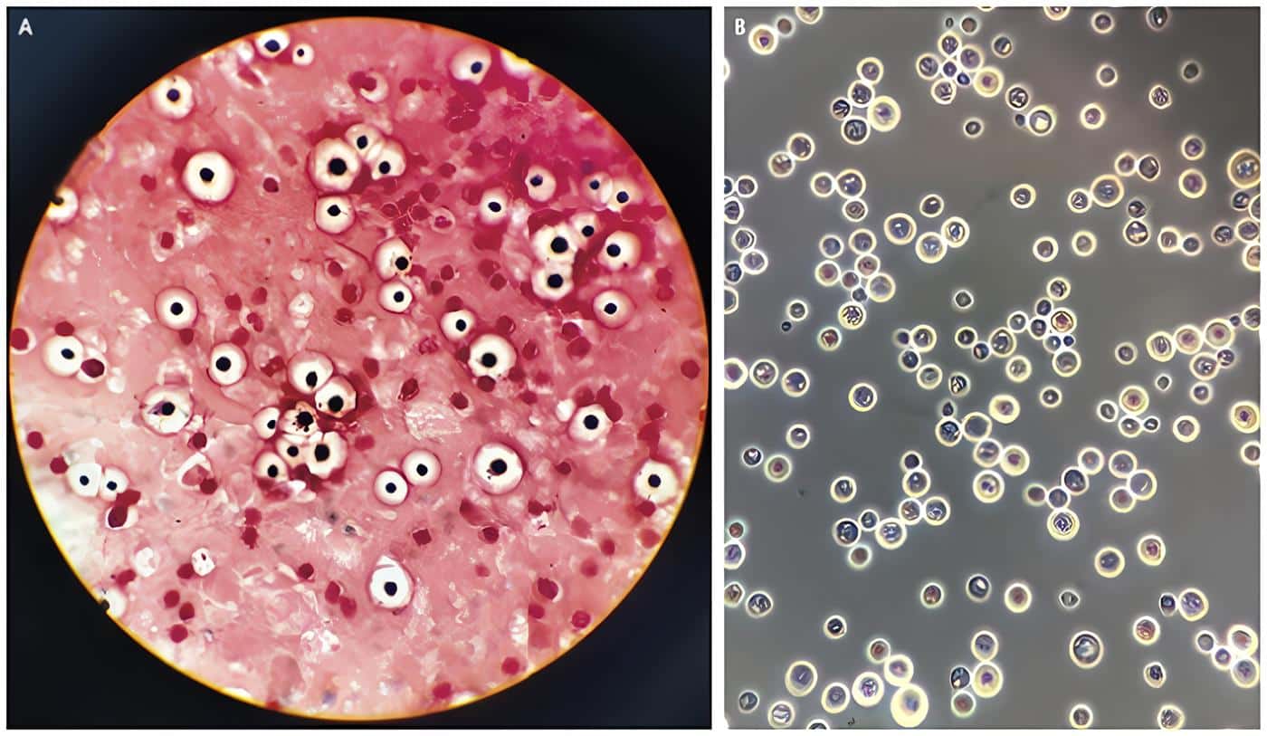 Cryptococcus Neoformans