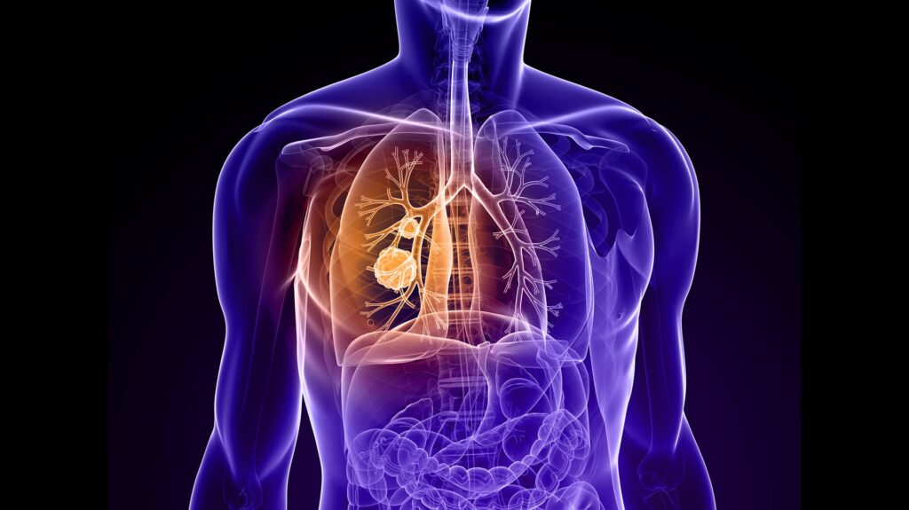 Ausencia unilateral congénita de la arteria pulmonar en adultos