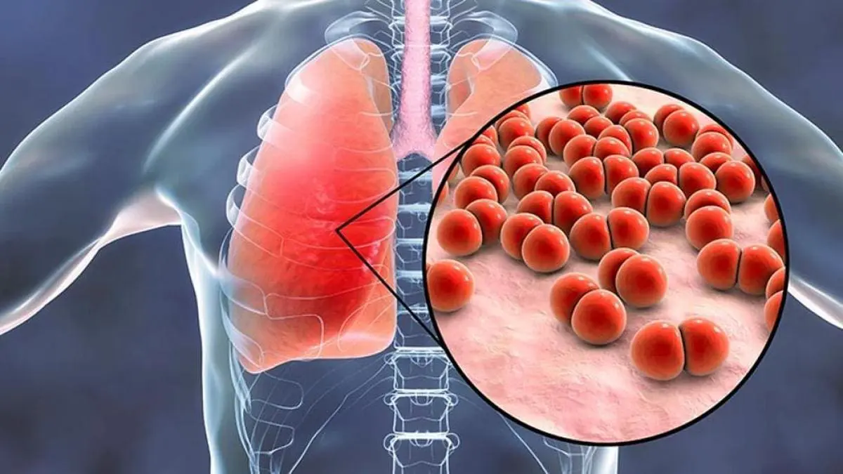 Herpes virus como posible responsable de un caso de neumonía