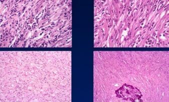 Pseudotumor Inflamatorio Endobronquial