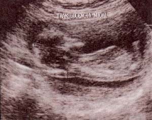 Traslucencia nucal patológica en feto afecto de trisomía 21