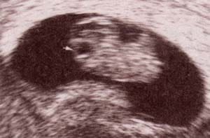 Diagnóstico Prenatal -  Desarrollo del polo cefálico