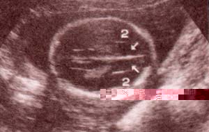 Diagnóstico Prenatal -  Cortes pronto-occipitales normales