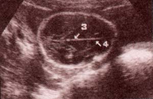 Diagnóstico Prenatal -  Cortes pronto-occipitales normales