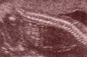 Diagnóstico Prenatal- segundo trimestre. 21 semanas. corte longitudinal