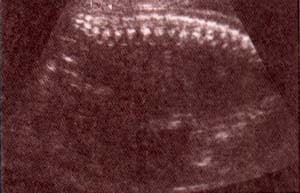 Diagnóstico Prenatal - 25 semanas. corte longitudinal