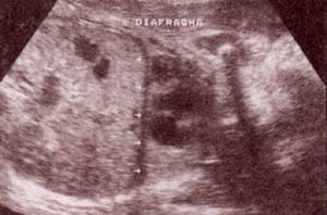 Diagnóstico Prenatal  - Tórax - diafragma