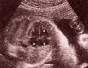 Diagnóstico Prenatal -  corazón corte 4 cámaras