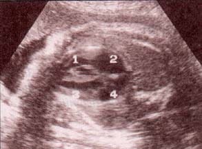 Diagnóstico Prenatal -  proyección subcostal
