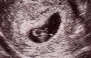 binomio embrión- vesícula vitelina en un embarazo de 7 semanas.