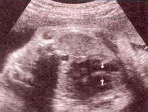 Diagnóstico Prenatal -  septum i-v. septum i-v. 32 semana