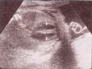 Diagnóstico Prenatal -  septum i-v íntegro entre las flechas