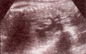 Diagnóstico Prenatal -  cayado aórtico