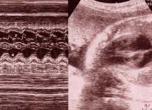 Diagnóstico Prenatal -  a nivel ventricular.