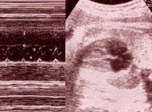 Diagnóstico Prenatal -  a nivel del foramen oval