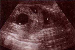 Abdomen Fetal Normal, 33 semanas