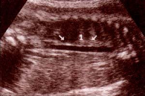 Abdomen fetal normal, Aorta Abdominal