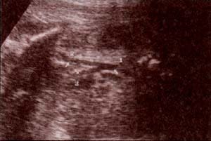 Abdomen Fetal, 33 semanas, aorta por debajo de las renales