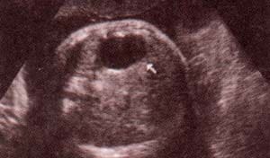 Abdomen Fetal Normal, Estómago y Vesícula Biliar