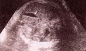 Abdomen Fetal, Vesícula Biliar a las 34 y 38 semanas respectivamente