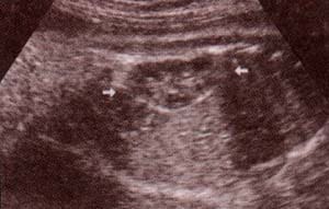 Abdomen Fetal, riñones y glándula suprarrenal