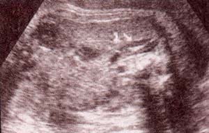 Abdomen Fetal, Glándula suprarrenal